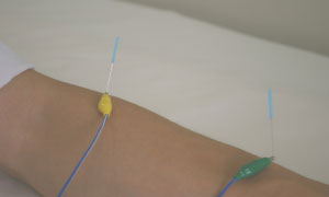 ～低周波鍼通電療法～ 刺入した鍼に低周波電流を流す方法です